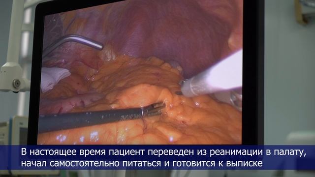 В Клинике факультетской хирургии № 2 Сеченовского Университета провели сложнейшую операцию